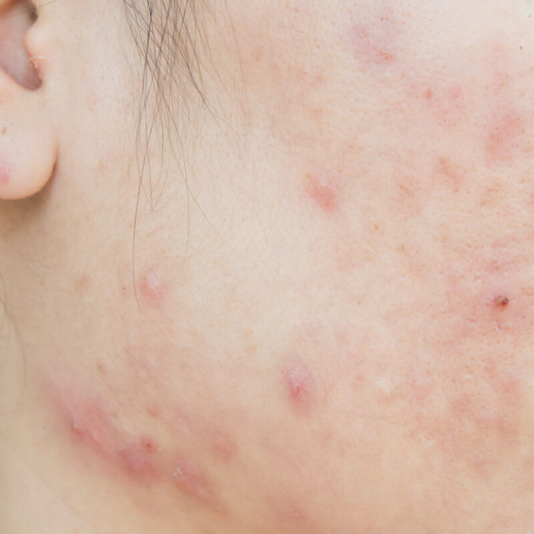 epivyziva-lexikon-nemoci--akne