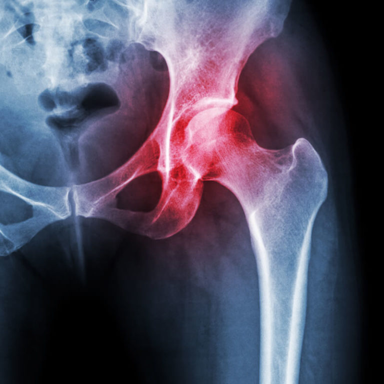 epivyziva-lexikon-nemoci-osteoporoza