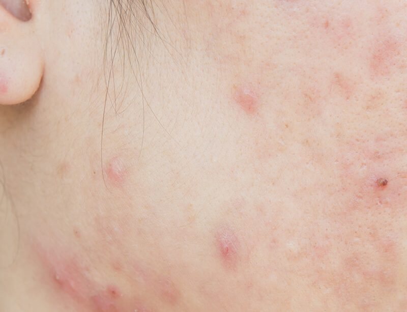 epivyziva-lexikon-nemoci--akne