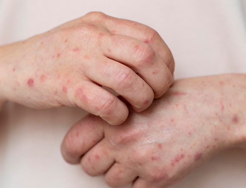 epivyziva-lexikon-nemoci-lupenka