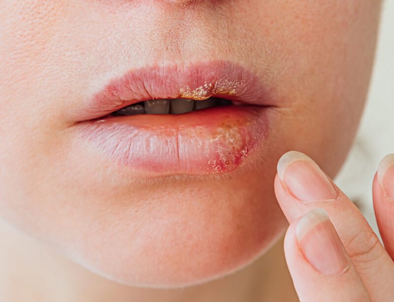 epivyziva-lexikon-nemoci-opary