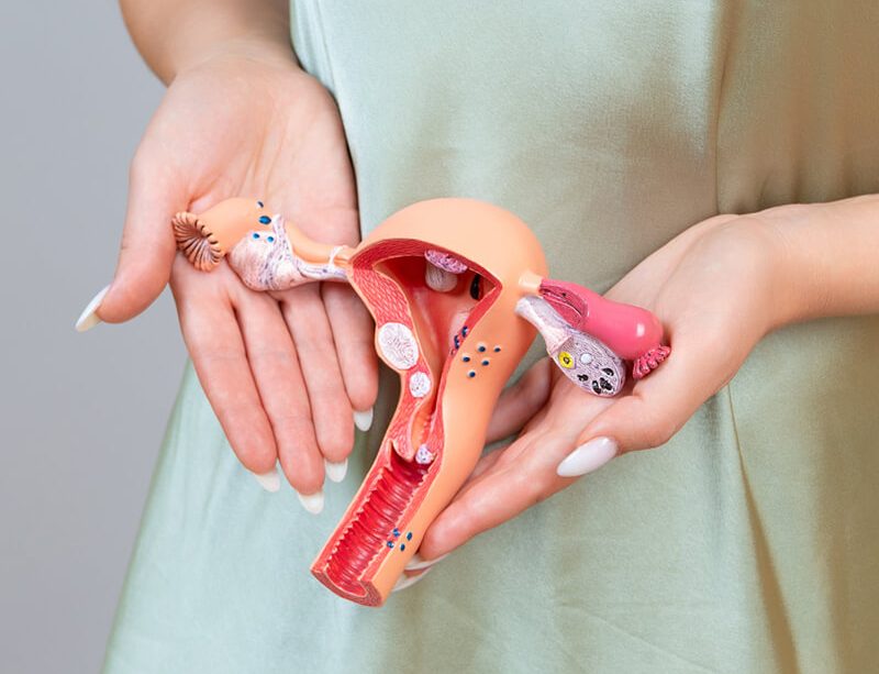 epivyziva-lexikon-nemoci-syndrom-polycystickych-ovarii