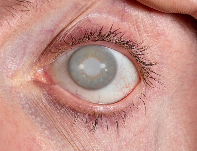 epivyziva-lexikon-nemoci-zeleny-zakal